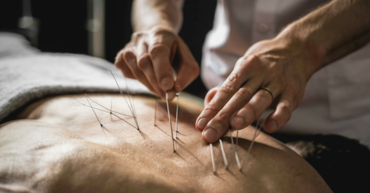 Exploring Dry Needling Therapy